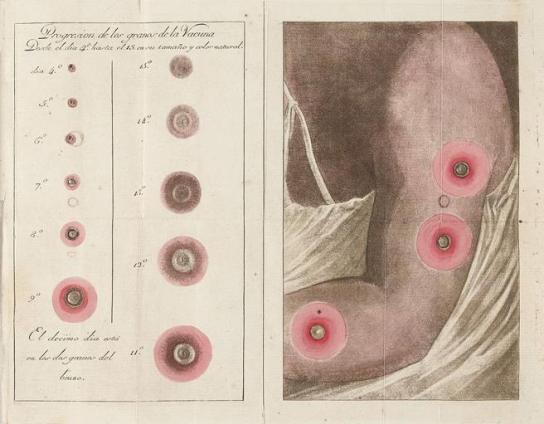 La viruela de&nbsp;1793